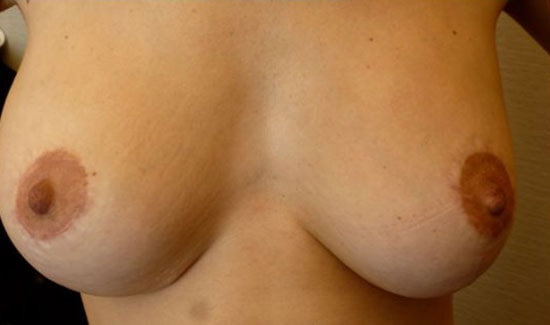 bonetti-gallery-areola-nipple-05