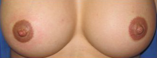 bonetti-gallery-areola-nipple-06